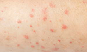 simptom influenza: radang kulit