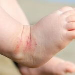 penjagaan kulit bayi