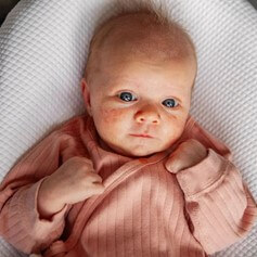 Jerawat Bayi