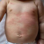 Kulit Sensitif Bayi