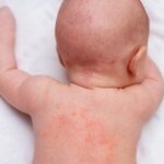 Kulit Sensitif Bayi