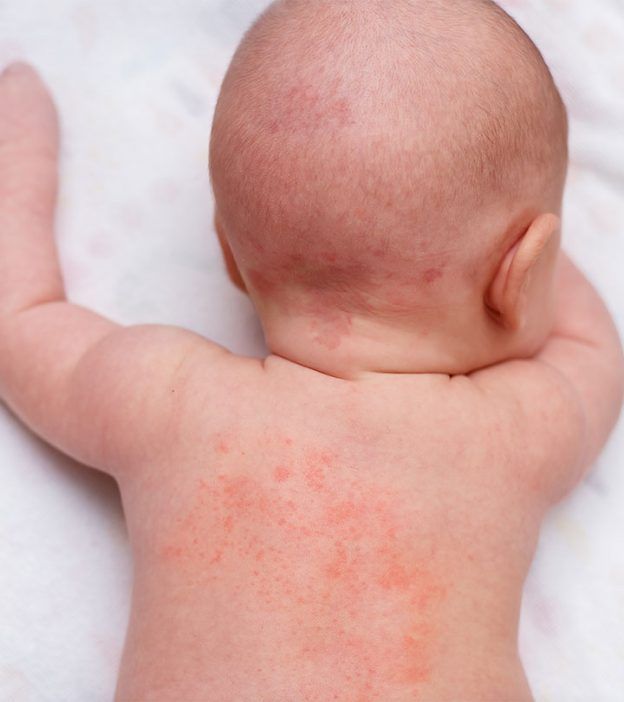 Kulit Sensitif Bayi